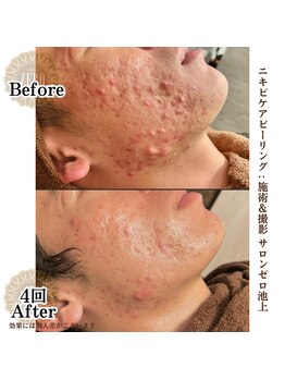 サロンゼロ 池上店(Salon ZERO)/ご予算、肌質で選べるニキビケア