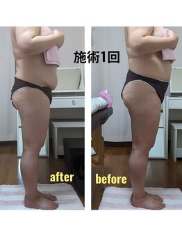 紬(TSUMUGI)/硬くなった脂肪。サイズダウン