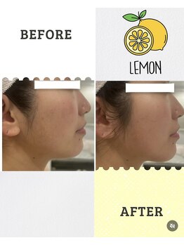 バーグトータルビューティー(bague total beauty)/韓国発レモンボトルで小顔へ