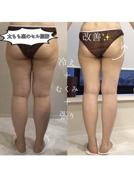 ボディベルム(BODY BELM)/太もも裏のセル脂肪！