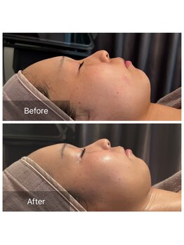 エヌア(nA)/ビフォーアフタービオフィート♪