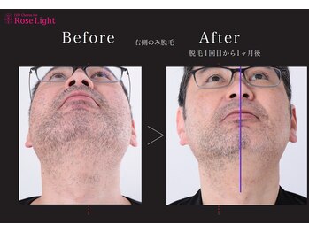 ヘルディン(heldin +555)/メンズ脱毛