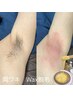 剃った後のジョリジョリ卒業！黒ずみを解決◎  両ワキ　wax脱毛　￥3,900