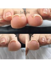 ネイルアンドアイラッシュ アヴィ(Nail and Eyelash A'vi)/巻爪補正