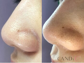 キャンディ 名古屋金山店(CANDi)/【毛穴専門店】ハーブピーリング