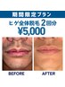 【卒業できる】ヒゲ全体脱毛2回パック¥5000★特別保湿仕上げ