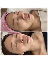 アネラ(ANERA)/むくみスッキリ♪カーボキシー