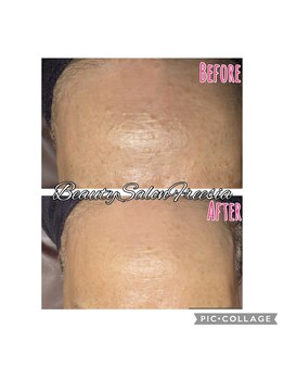フリージア(Beauty Salon Freesia )/美肌菌活ピール1回目稗粒腫改善