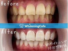 ホワイトニングカフェ 豊中店(WhiteningCafe)/◎歯のホワイトニング施術写真◎