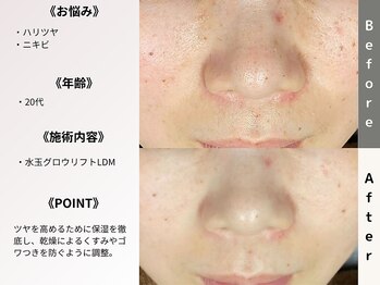 ルディラ 上野店/水玉グロウリフト(韓国式LDM)