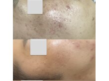 M 北千住店(の雰囲気（一度でこのお肌の変化♪）