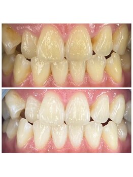 セルフ脱毛サロン SELFMADE イオンタウン仙台泉大沢店【3/29 NEW OPEN(予定)】 /ホワイトニングビフォーアフター