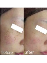 ブランシェ 金沢店 × 椿/シミケア　『30代お客様』