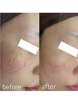 ブランシェ 金沢店 × 椿/シミケア　『30代お客様』