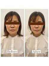 クレファ(CREFA)/圧倒的小顔術