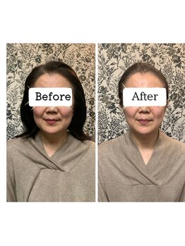 ストロベリーキャンドル/目指すはシャープな立体小顔