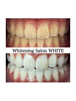 ホワイトニングサロン ホワイト 津山店(WHITE)/ビフォーアフター