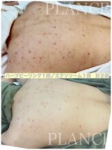 プランス 恵比寿店(PLANCE)/頑固な背中のお悩みに