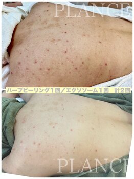 プランス 恵比寿店(PLANCE)/頑固な背中のお悩みに