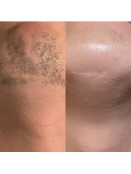 ボディデザイン ビィーラボ(BODY Design BE Labo)/大人気のヒゲ脱毛