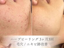 ベルペール(Belle perle)/【ハーブピーリング】毛穴/シミ