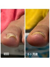 ドクターネイル爪革命　松戸 【巻き爪・魚の目・角質ケア・変形爪】/巻き爪矯正