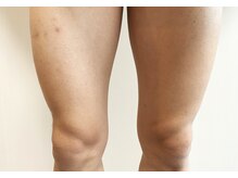 アトリウムオム 博多(ATRIUM HOMME)/1ヶ月半剃毛なしでこの状態！