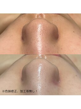 ファウンデーション(FOUNDATION)/顔脱毛×ハイドラフェイシャル