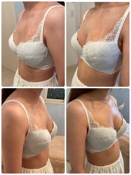 メゾン アンジュ(Maison Ange)/バストアップ症例/バストケア