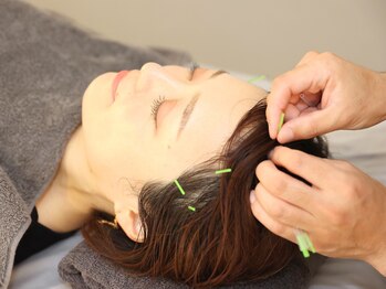 シーキュア 三宮元町(C-cure)/「頭針」による頭痛改善