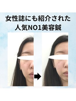 ゆず鍼灸整骨院/GINGERに紹介された美容鍼