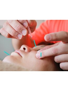 鍼灸施術を受けたい