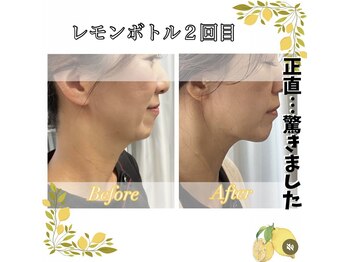 バーグトータルビューティー(bague total beauty)/レモンボトルで小顔効果！