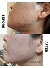 ゼロプラス(ZERO+)/【フェイシャル】ヒト幹細胞