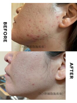 ゼロプラス(ZERO+)/【フェイシャル】ヒト幹細胞