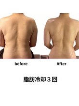 エミット(emit.)/脂肪冷却　ビフォーアフター