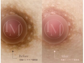 チェルビー(chelbe)の写真/【韓国で話題のルメラで色素沈着改善】人には相談しづらいバストトップのお悩みに寄り添うケア
