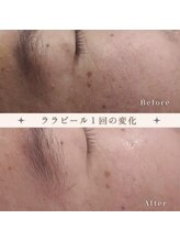 アリアンド(ari.and)/ララピール　症例写真