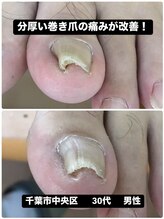 巻き爪じゅん 千葉駅前店/硬い巻き爪による痛みから解放