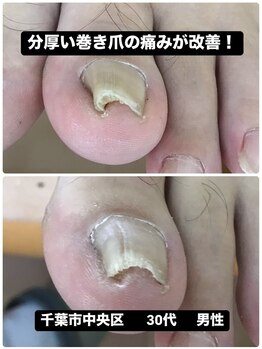 硬い巻き爪による痛みから解放