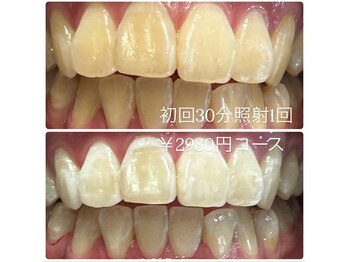 ホワイトニングルーム 横浜店(Whitening Room)/ホワイトニング/横浜