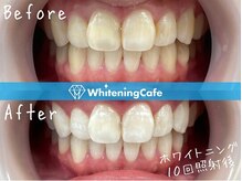 ホワイトニングカフェ 豊中店(WhiteningCafe)/◎歯のホワイトニング施術写真◎