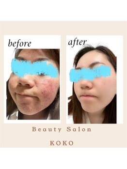 ココ(KOKO)/BeforeAfter