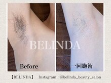 ベリンダ(BELINDA)/脱毛 (認定脱毛講師 在籍サロン)
