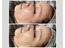 シュシュ(Chou chou)/【Before★After】赤み・くすみ