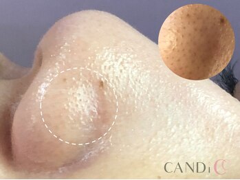 キャンディ 名古屋金山店(CANDi)/ピーリングで黒ずみ毛穴解決♪