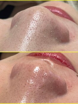 フローレント(Florent)/毛穴洗浄ハイドロフェイシャル