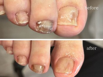 爪のいろは/見た目も大切♪巻き爪補正