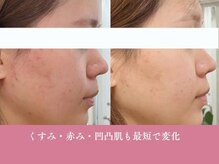 モアビューティー 楽々園店(MORE BEAUTY)の雰囲気（あなたのお悩みに応じて適切なコースをご提案します）