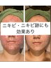20～30代必見☆【ニキビケア・肌荒れ・毛穴悩み】オプション付き♪￥11,000